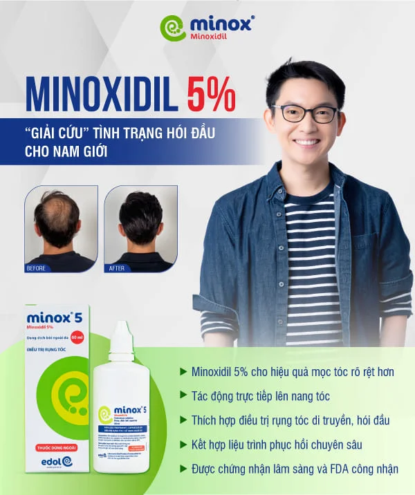 Minox5 khuyến nghị sử dụng cho nam giới ngay từ đầu để đạt hiệu quả tối ưu kích thích mọc tóc mạnh hơn và cho kết quả nhanh hơn, nhưng cũng có nguy cơ gây kích ứng cao hơn