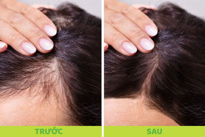 Tóc rụng nhiều, rụng bất thường không chỉ làm ảnh hưởng đến thẩm mỹ mà còn là một dấu hiệu cảnh báo bạn đang mắc bệnh