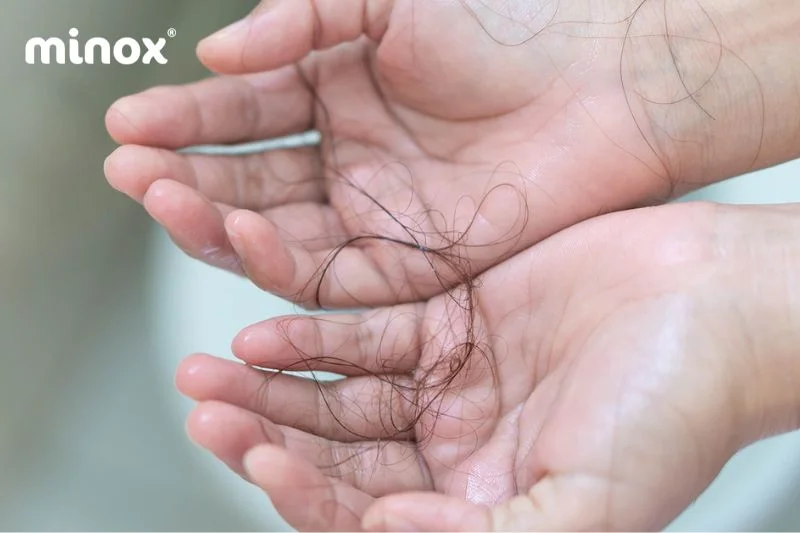 Tóc rụng quá nhiều có thể do stress hoặc mất cân bằng nội tiết tố