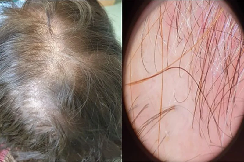 Rụng tóc Telogen thường biểu hiện với một lớp tóc mỏng lan tỏa trên da đầu