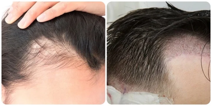 Sau cấy tóc, nhiều người có thể bị rụng tóc tạm thời, Minoxidil có thể giải quyết tình trạng này