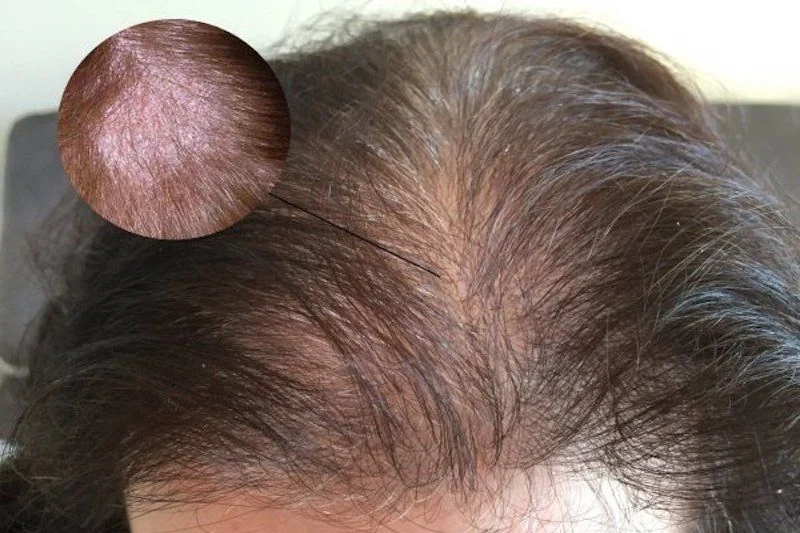 Bệnh vảy nến da đầu xảy ra khi các tế bào da bị rối loạn làm nổi các mảng vảy đỏ