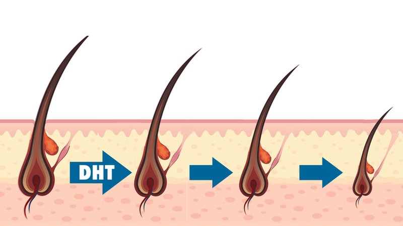 Nồng độ hormone DHT tăng cao có thể làm cho nang tóc bị teo lại và dễ gãy rụng