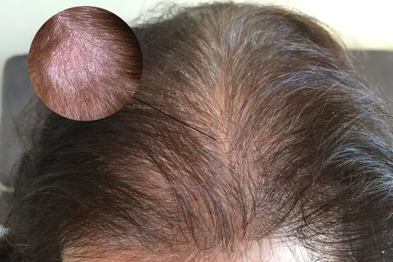Kích ứng da đầu gây ngứa ngáy, rụng tóc, nổi mụn, phát ban đỏ ở da đầu rất khó chịu