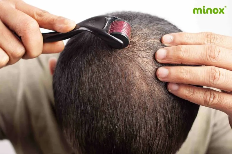 Lăn kim điều trị rụng tóc cần diễn ra trong môi trường y khoa để tránh các biến chứng và nhiễm trùng