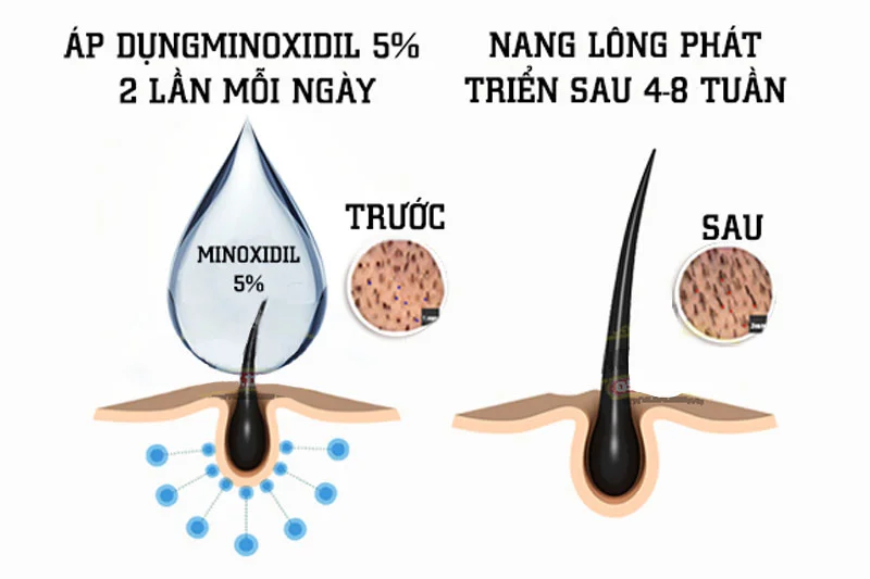 Thuốc mọc tóc Minoxidil 5% có hiệu quả rõ rệt sau 2-4 tháng sử dụng