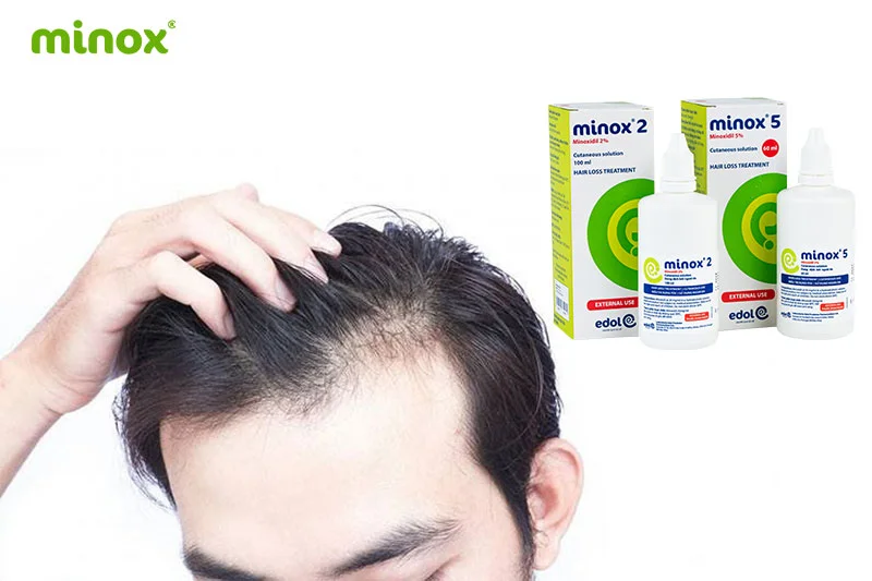 Minoxidil được sử dụng rộng rãi trong điều trị rụng tóc, phù hợp khi da đầu vẫn còn nang tóc