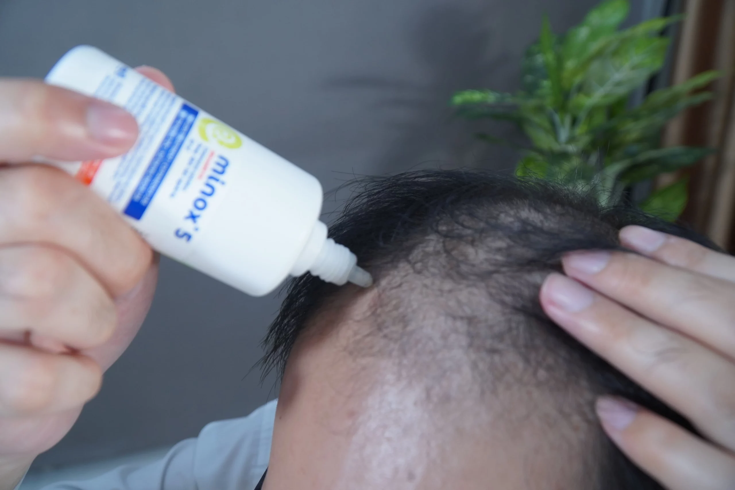 Minoxidil kích thích mọc tóc ở các cá nhân rụng tóc do nội tiết tố androgen