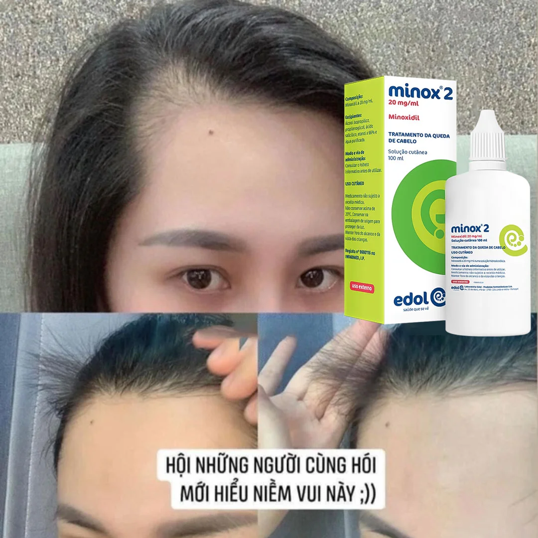 Minoxidil kích thích tóc con mọc ra tua tủa, hỗ trợ trị hói hiệu quả
