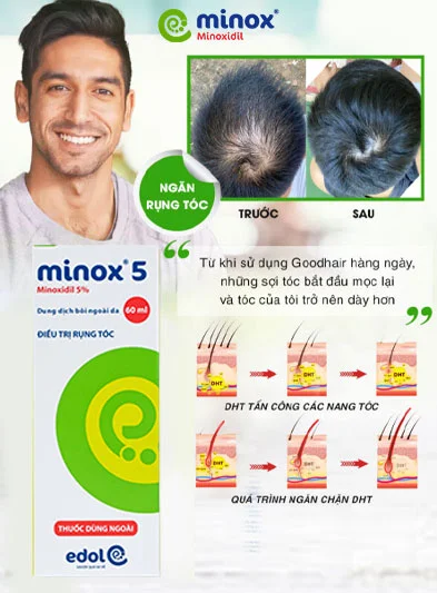 Minoxidil làm giãn mạch, tăng lưu thông máu, giúp đưa dưỡng chất đến nuôi lông tóc, hỗ trợ mọc tóc chắc khỏe, dày mượt