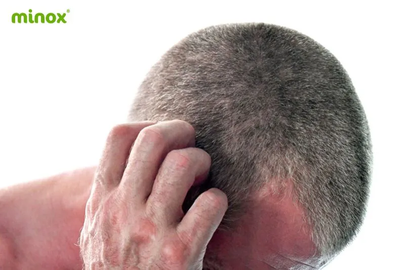 Ngứa, kích ứng vùng da đầu là một tác dụng phụ thường gặp khi dùng thuốc xịt Minoxidil