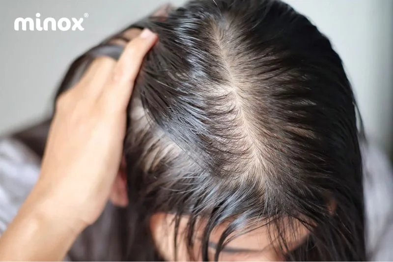 Tóc thưa thớt và mỏng yếu thường gây khó chịu và tự ti cho người bị mắc phải