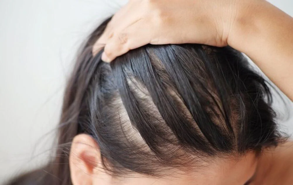 Tuyến bã nhờn trên da đầu hoạt động quá mức dẫn đến thừa dầu