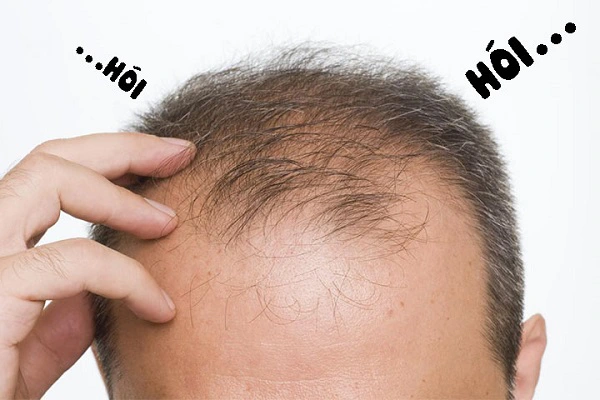 Hói di truyền ở nam giới có thể xuất hiện đột ngột hoặc diễn tiến trong thời gian dài