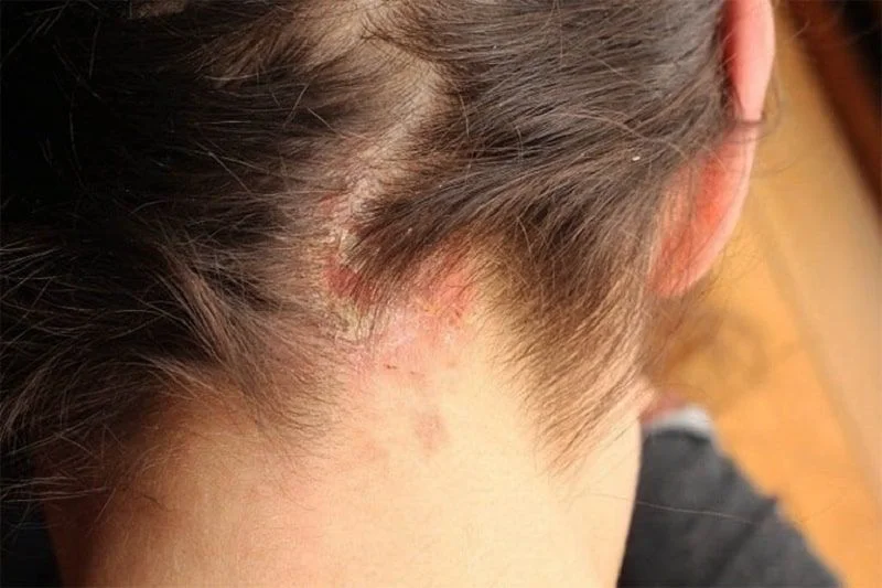 Da đầu ngứa, kích ứng có thể là tác dụng phụ của thuốc Minoxidil