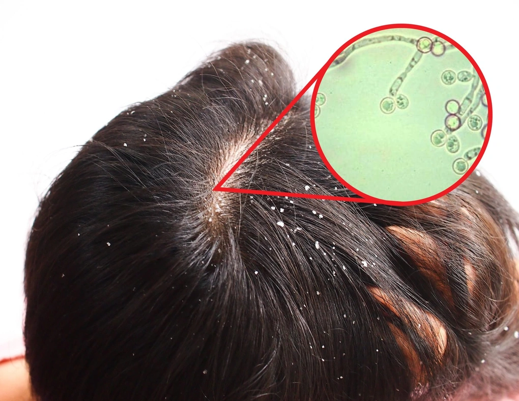 Mất cân bằng Microbiome da đầu gây ra các vấn đề như viêm da đầu, gàu ngứa và tăng tiết dầu
