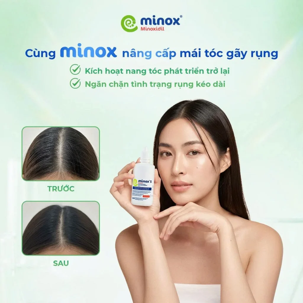 Minox-dieu-tri-rung-toc (1)
