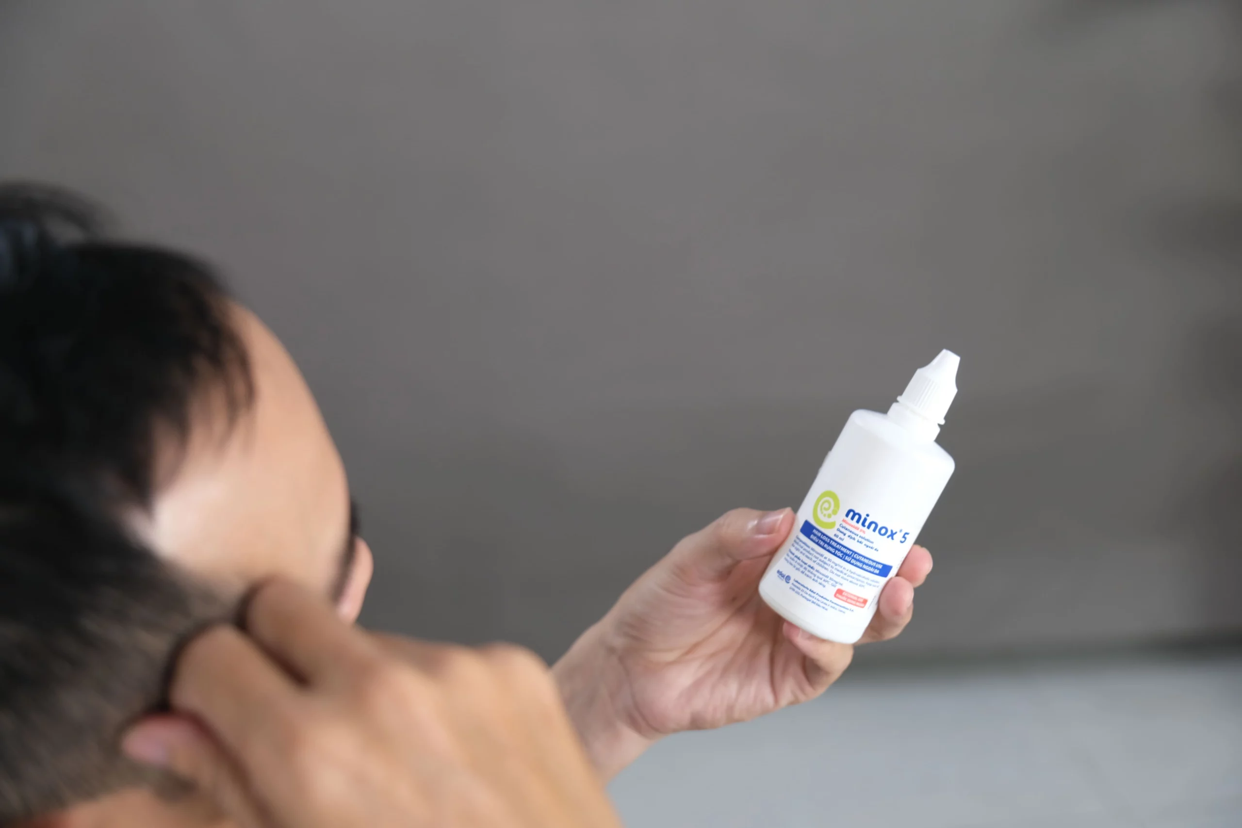 Minoxidil là thuốc được sử dụng để điều trị rụng tóc ở cả nam và nữ