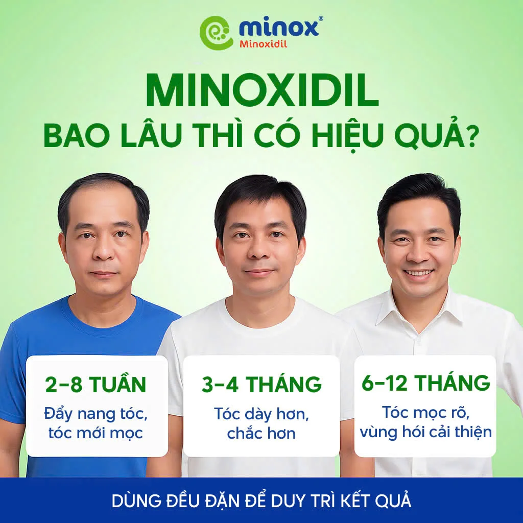 Minoxidil-tri-rung-toc-nam-gioi