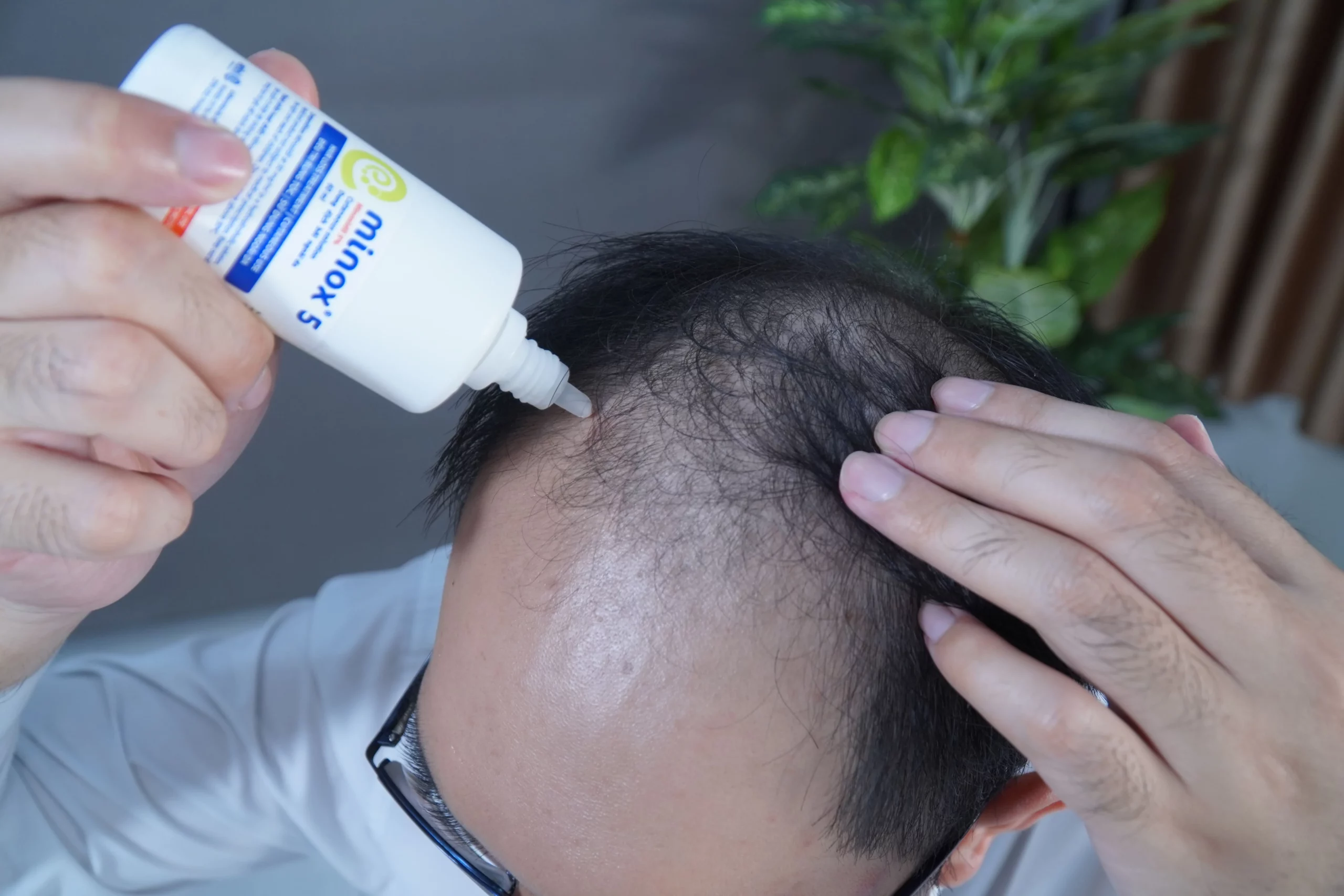 Minox có hiệu quả điều trị rụng tóc, hói đầu chữ M, hói vùng trán và đỉnh đầu