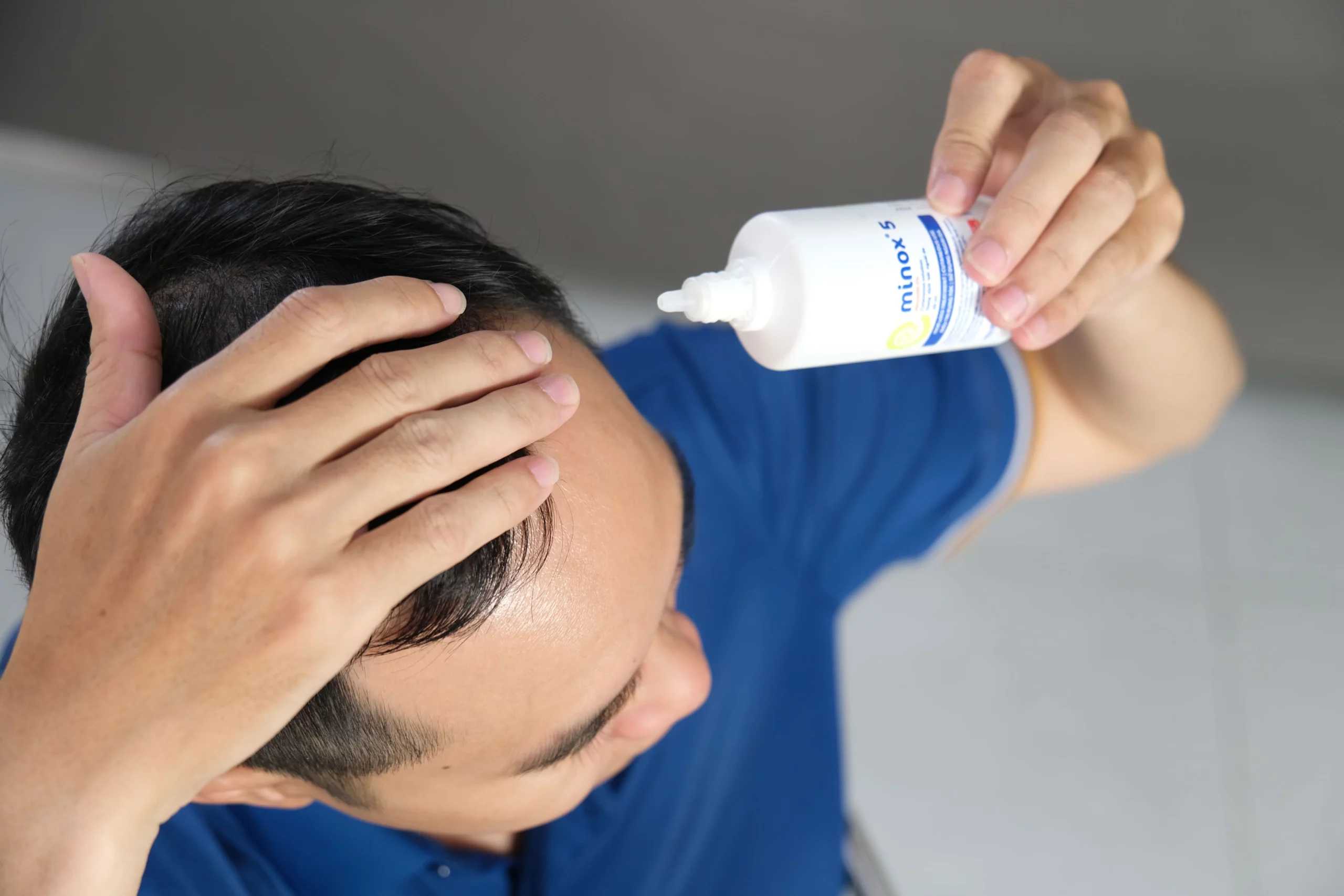 Minox dùng để điều trị rụng tóc mức độ trung bình ở người lớn với nguyên nhân do tăng tiết androgen