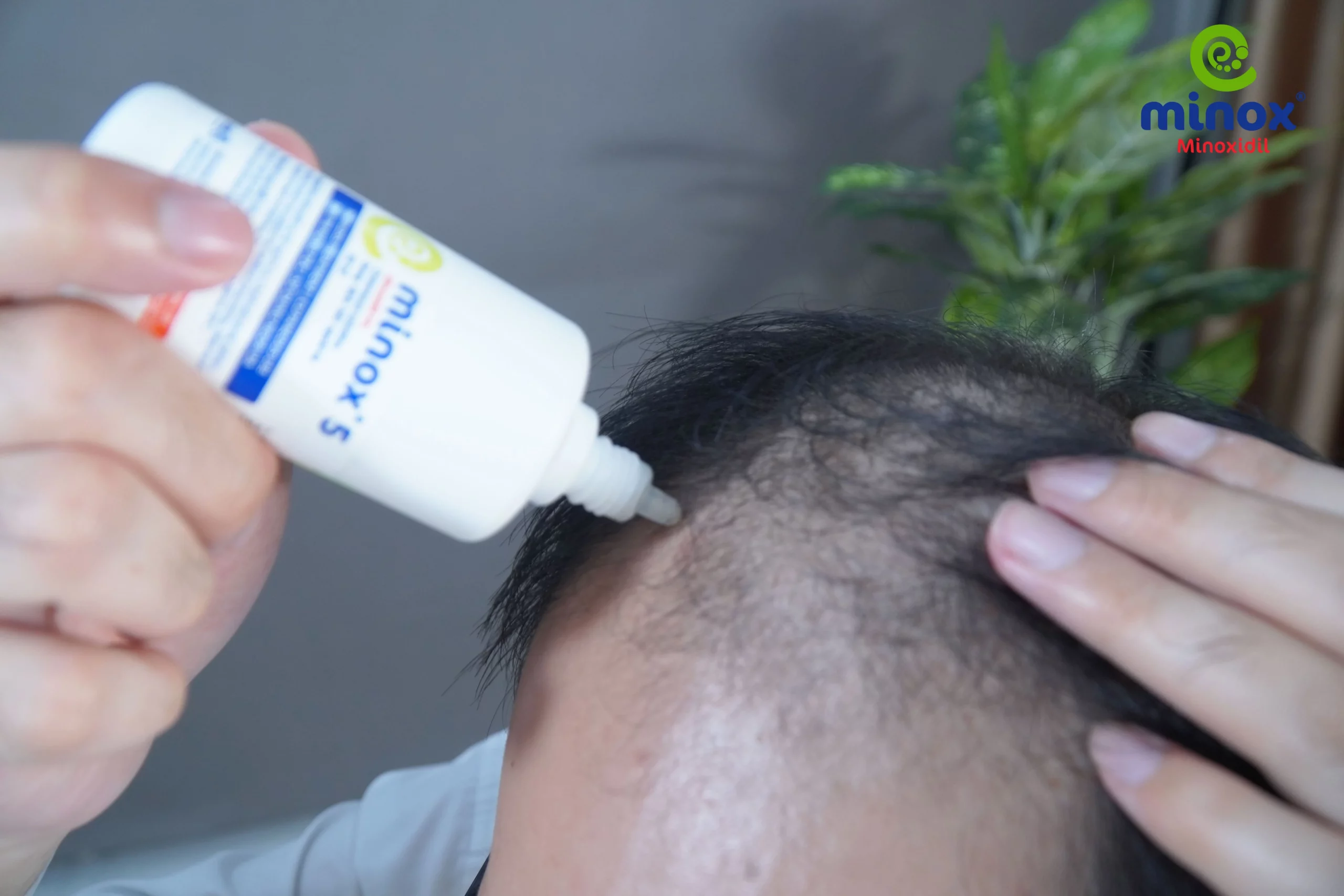 Nên massage da đầu nhẹ nhàng khi sử dụng Minox để tăng cường khả năng thẩm thấu Minoxidil giúp kích thích mọc tóc