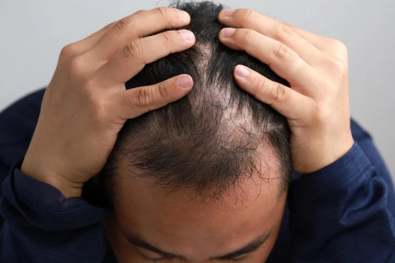 Trong bệnh Telogen Effluvium, stress quá mức và kéo dài sẽ đẩy một lượng lớn nang tóc vào giai đoạn nghỉ ngơi gây rụng tóc