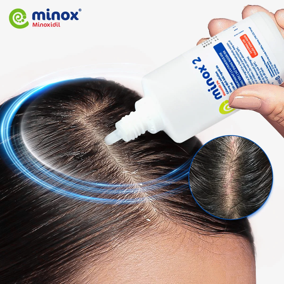 Minoxidil thẩm thấu sâu vào nang tóc, kích thích mọc tóc, hỗ trợ giảm viêm, bảo vệ nang tóc, phục hồi da đầu khỏe mạnh