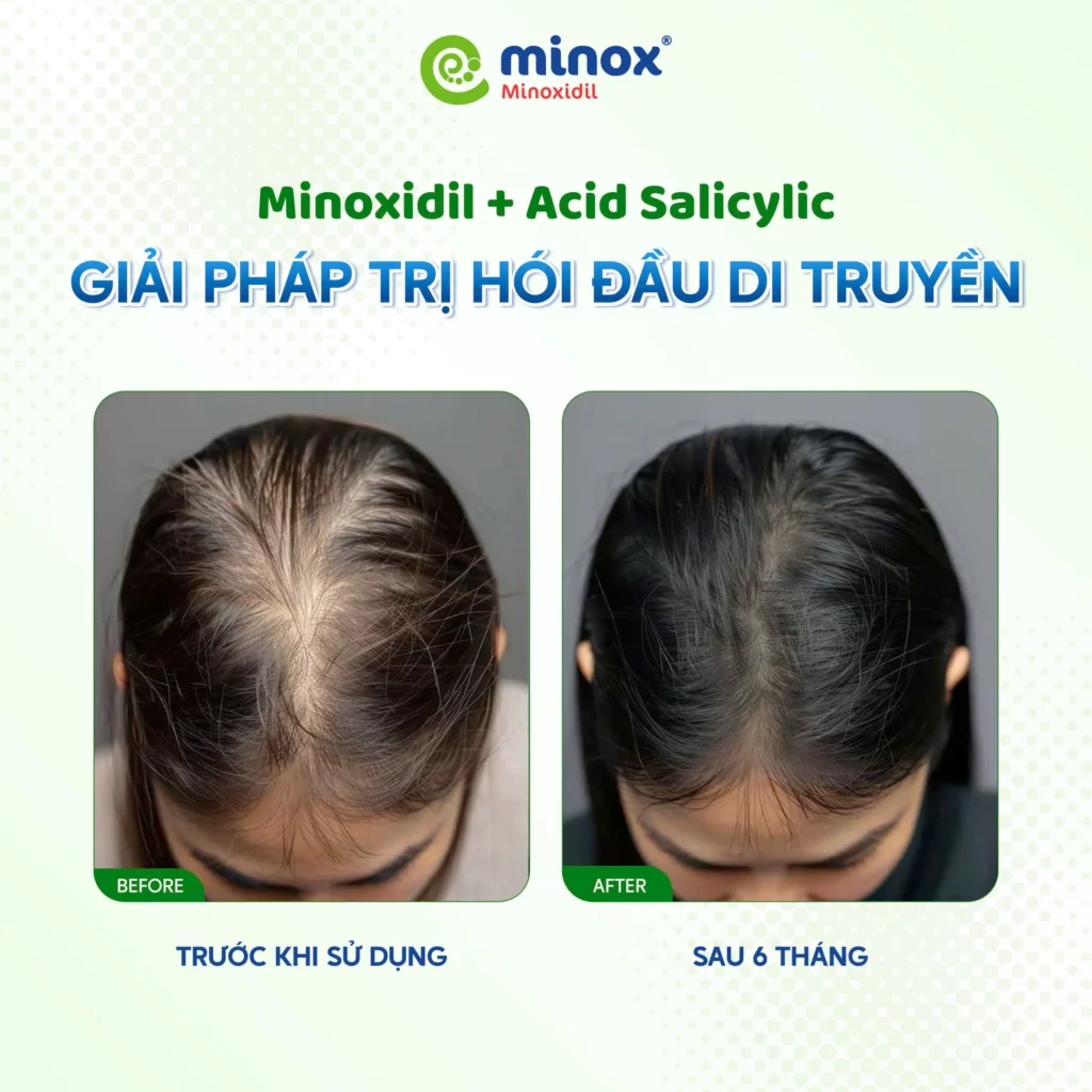 Minox-hoi-dau-di-truyen