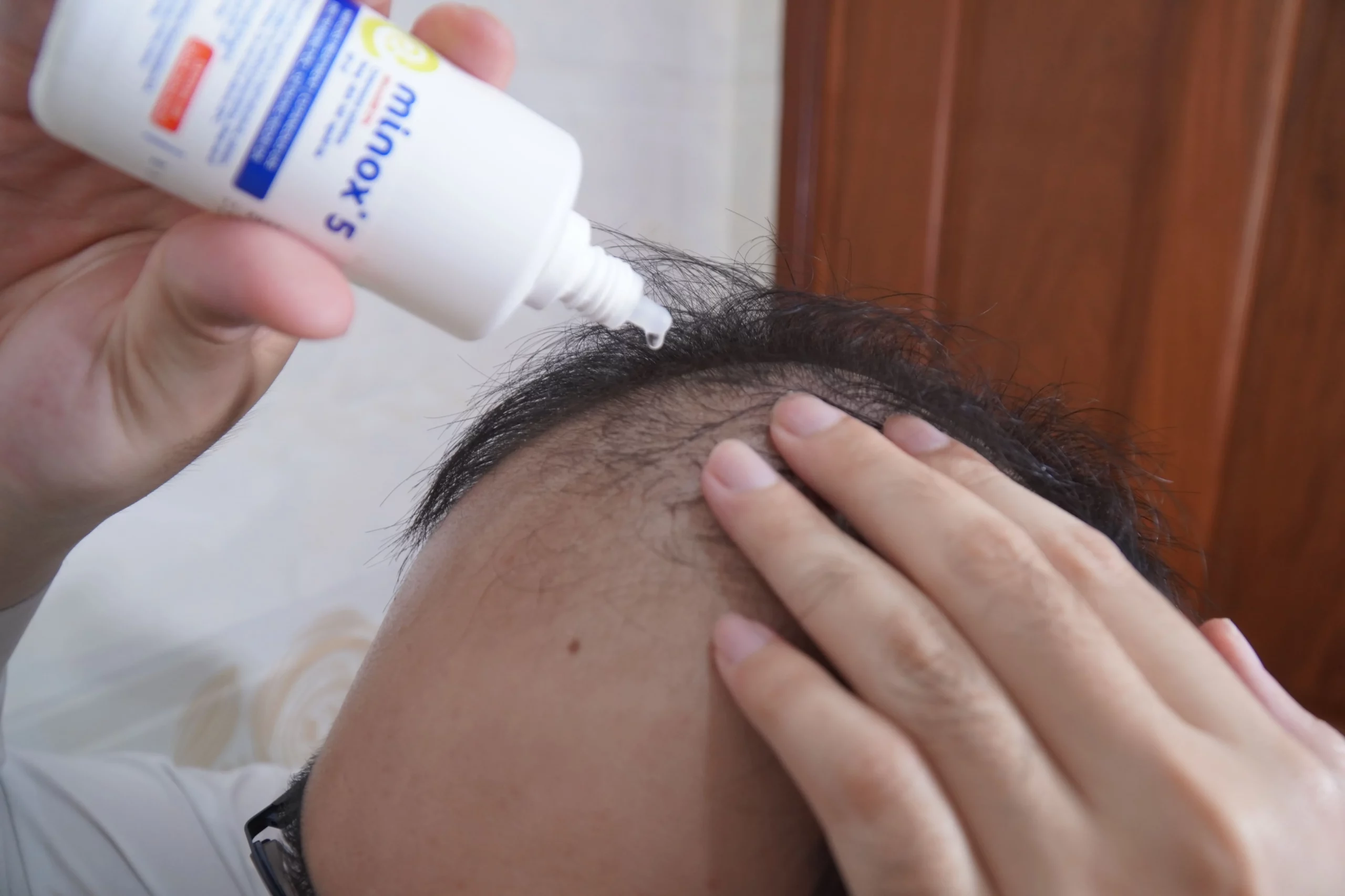 Minoxidil kích thích mọc tóc ở những người bị rụng tóc di truyền (Alopecia Androgenetica) giai đoạn sớm và trung bình