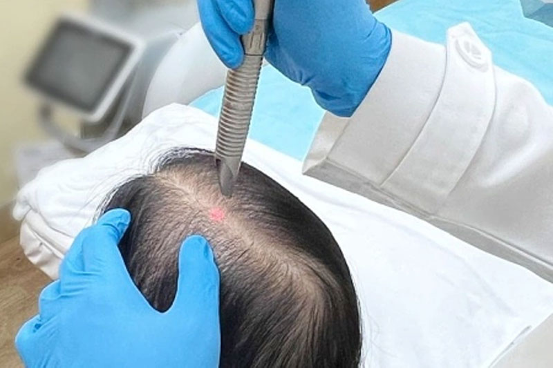 Bác sĩ điều tri laser cho bệnh nhận bị rụng tóc