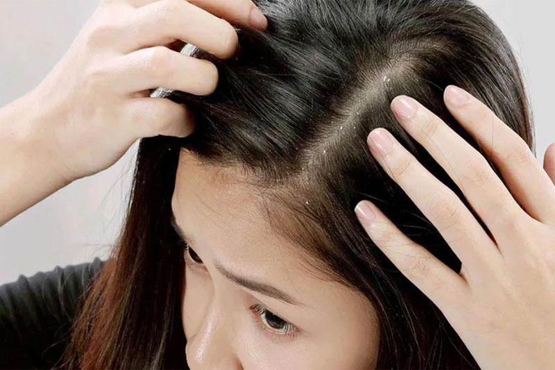 Salicylic Acid có tác dụng loại bỏ tế bào chết nhẹ nhàng, làm sạch da đầu và ngăn ngừa gàu hiệu quả
