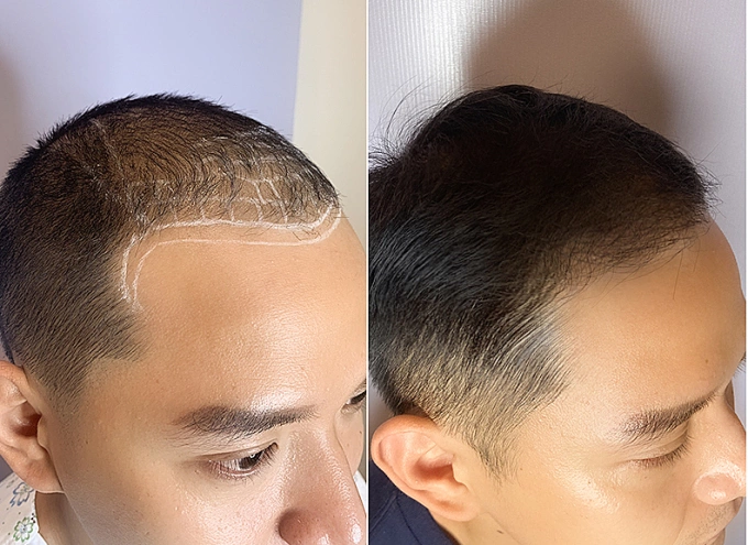 Kĩ thuật cấy tóc bóc tách các nang tóc khỏe mạnh phía sau gáy cấy trực tiếp lên phần da đầu bị hói