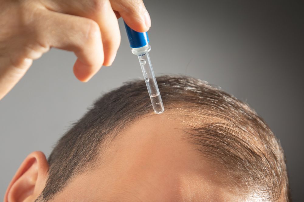 Minoxidil là hoạt chất được sử dụng ngoài da để điều trị hói và rụng tóc