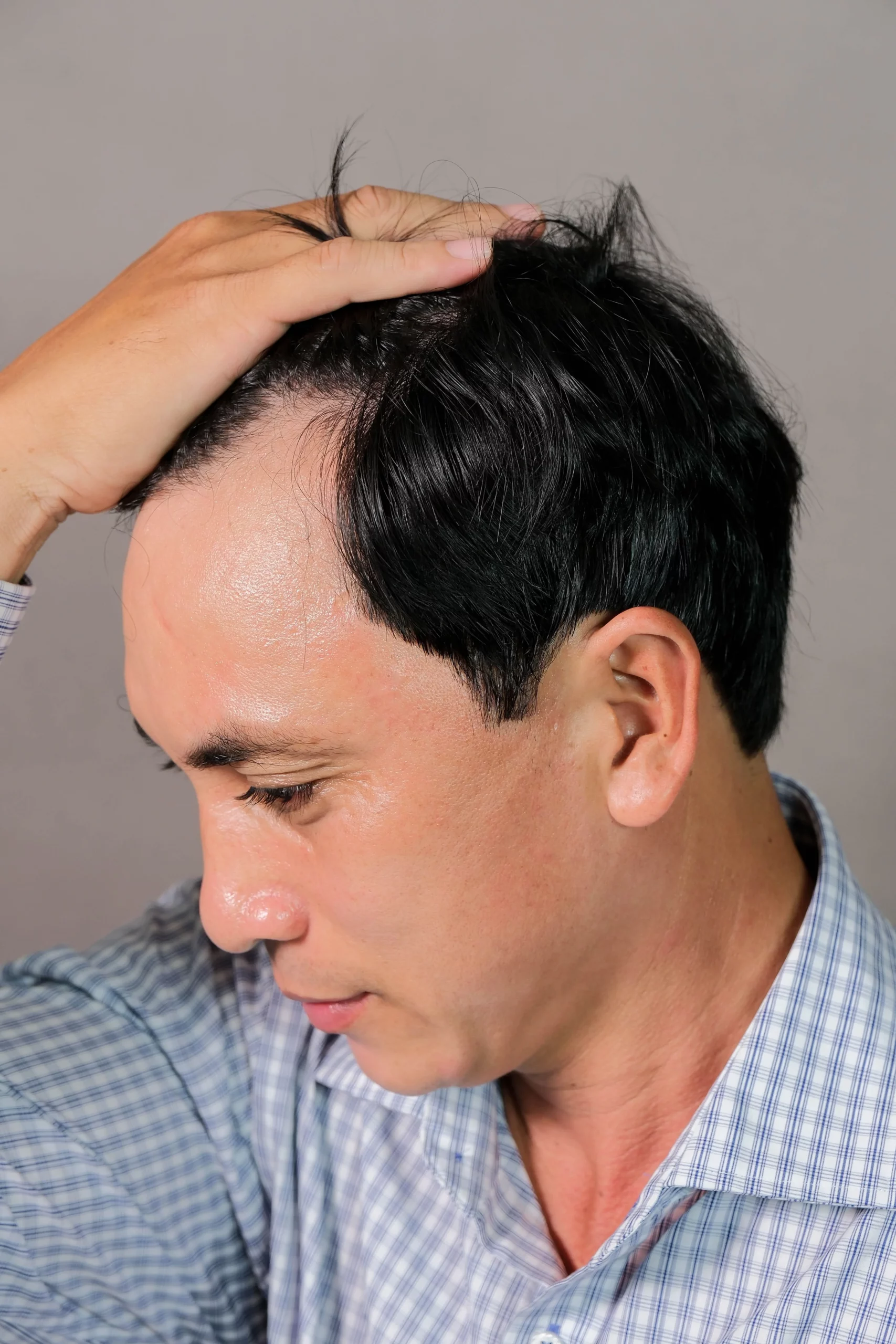 Hói chữ M ở nam giới là tình trạng tóc rụng ở hai bên trán và thái dương, tạo thành hình chữ "M" trên đường chân tóc