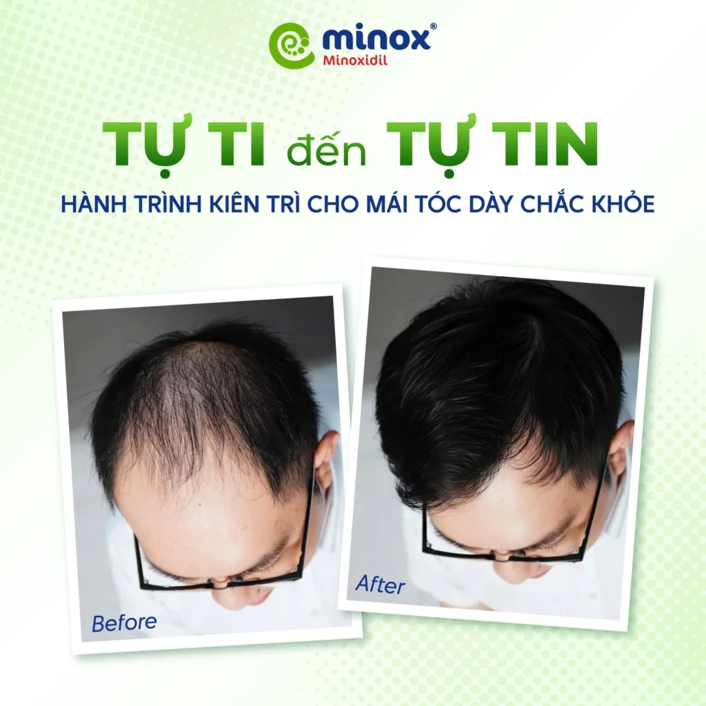 Minoxidil-moc-toc