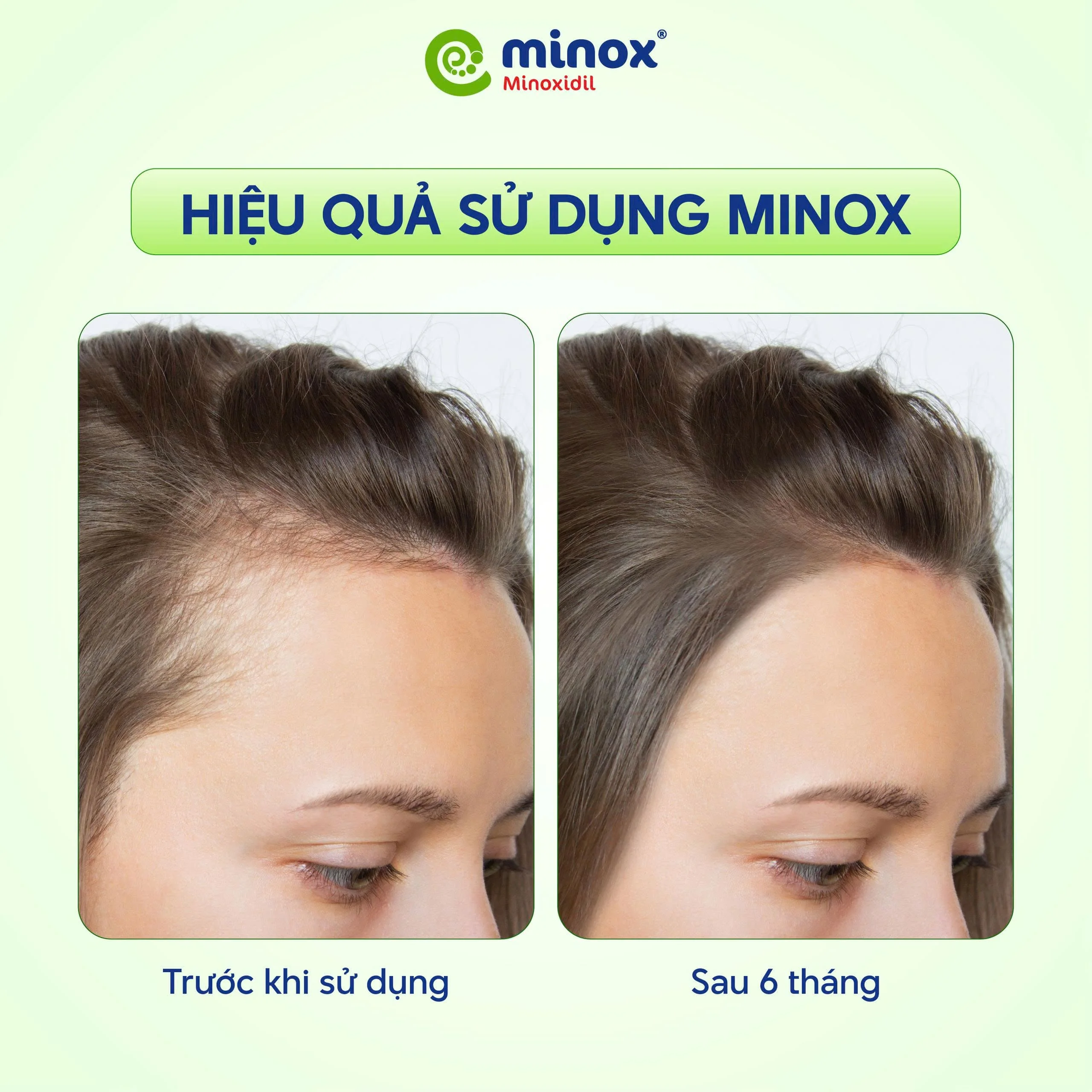 Minox có thể trị hói đầu và giúp tóc mọc lại nhanh chóng