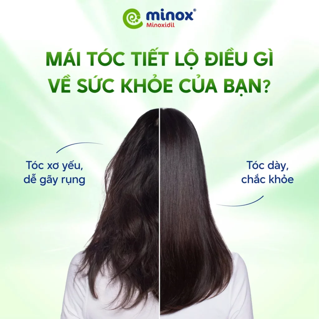 Minox-suc-khoe-toc