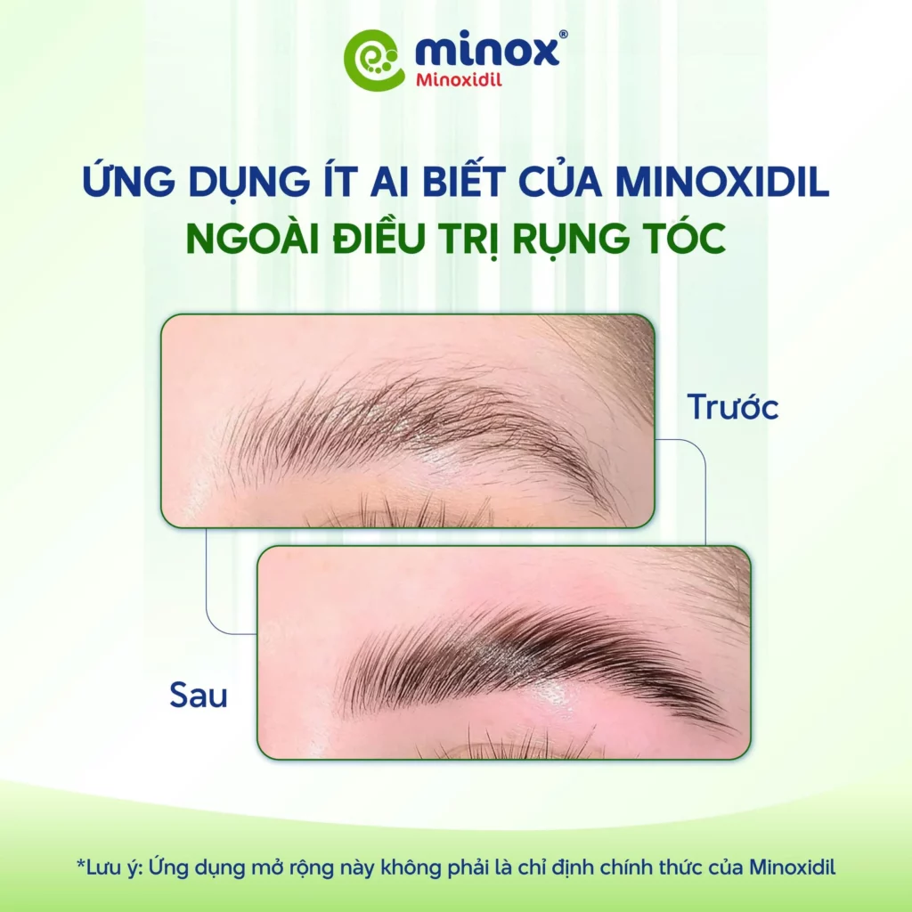 Minoxidil-moc-long-may