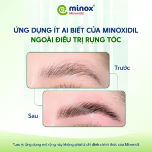 Minoxidil-moc-long-may