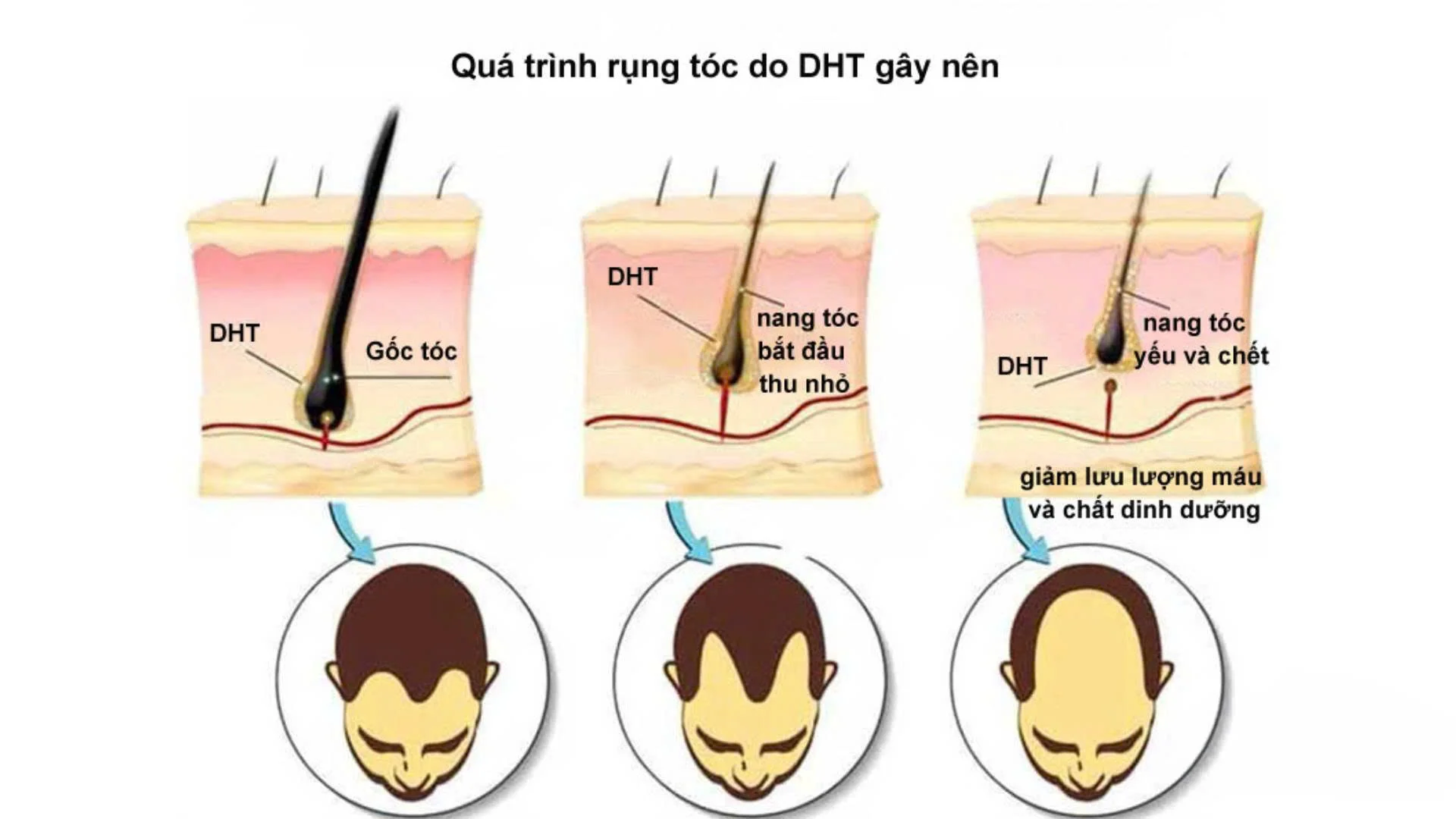 Rụng tóc nội tiết do DHT là tình trạng hormone này gắn vào nang tóc, làm chúng teo nhỏ, khiến tóc mọc yếu, mỏng và dễ rụng