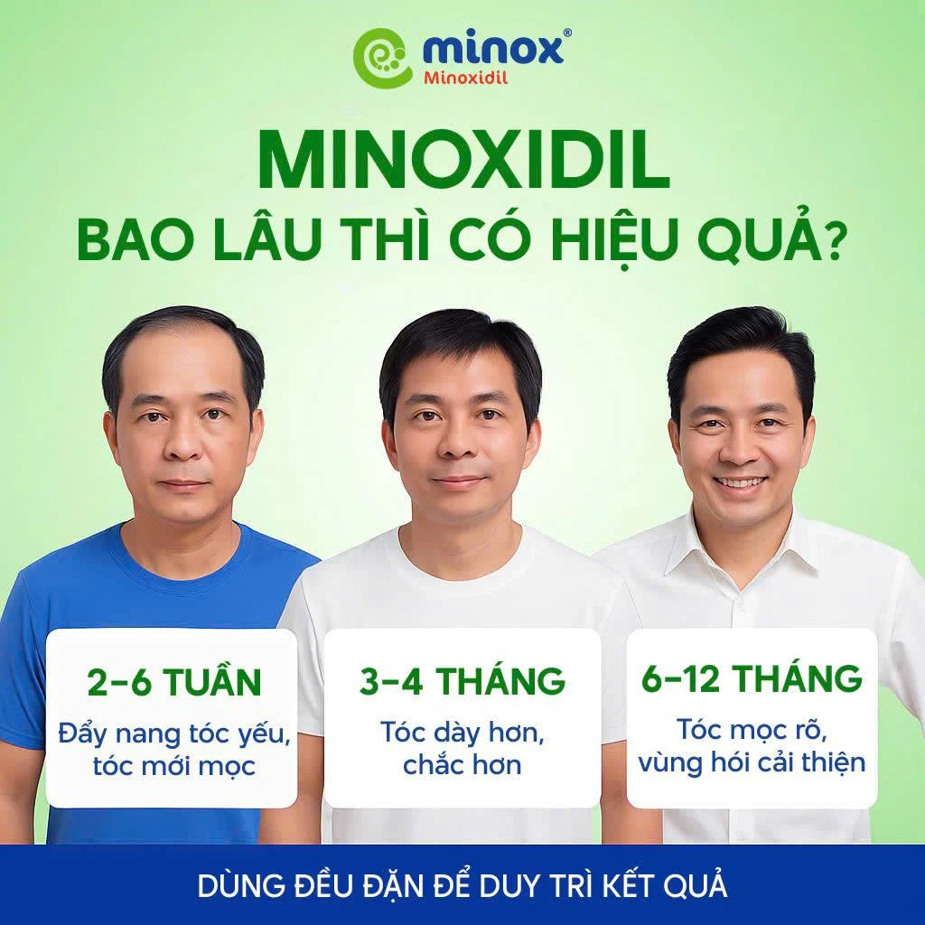 Để đạt kết quả tối ưu, bệnh nhân được khuyến nghị sử dụng Minoxidil đều đặn 1-2 lần/ngày trong ít nhất 6 tháng