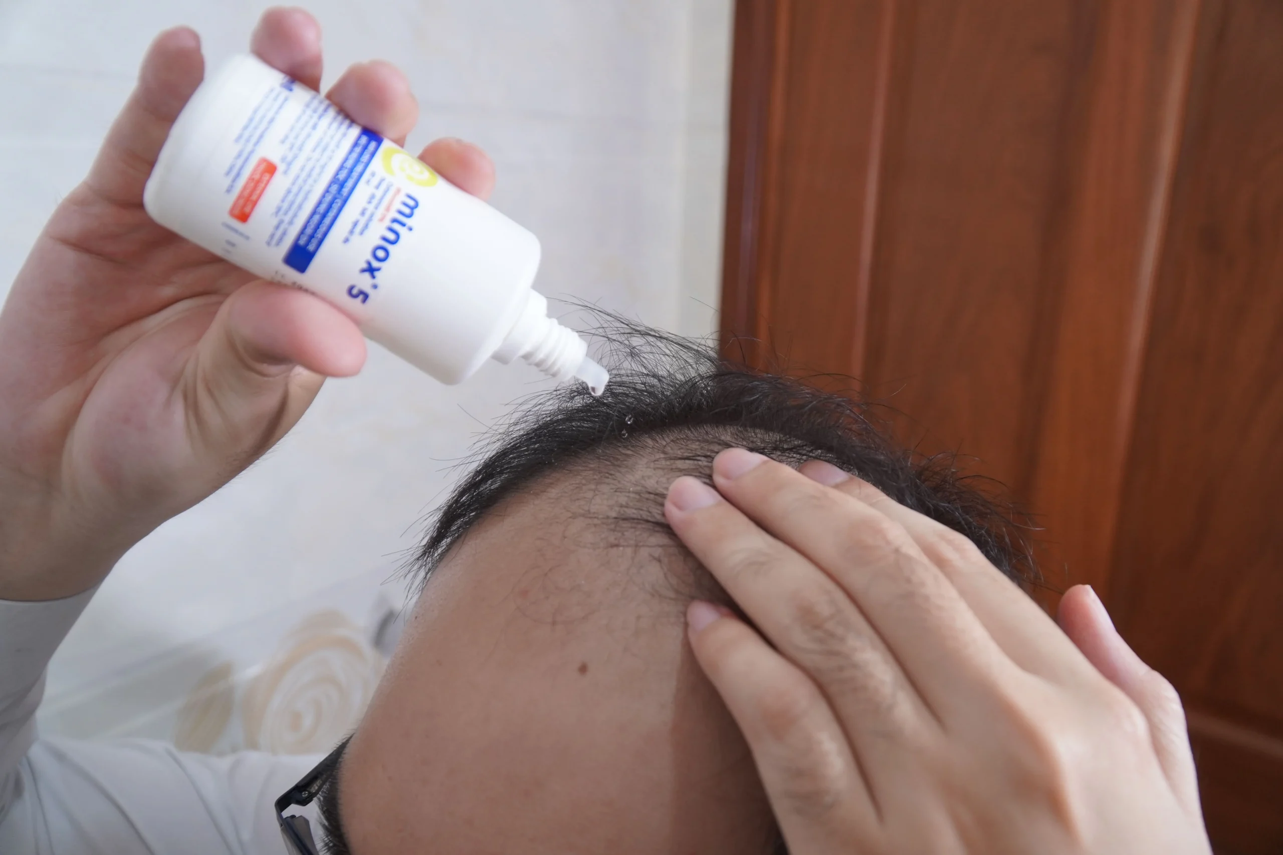 Minox 5 khuyến nghị cho nam, giúp kích thích mọc tóc và cho kết quả nhanh hơn, nhưng nguy cơ kích ứng cao hơn