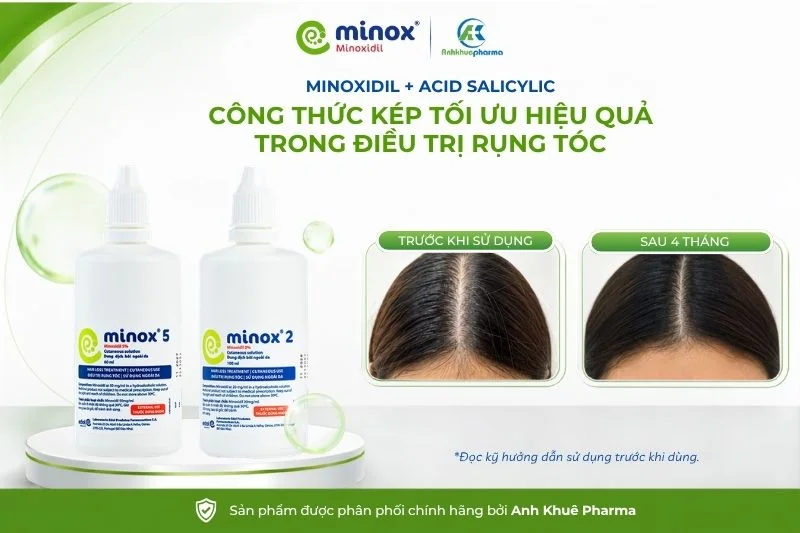 Minox - thuốc điều trị rụng tóc, hói đầu hiệu quả với công thức kép “Minoxidil + Acid Salicylic”