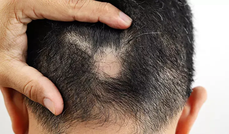 Tóc rụng theo mảng hình tròn trên đầu, mỗi mảng bằng đồng xu hoặc lớn hơn